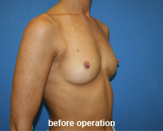 plastic-surgery-breast-augmentation